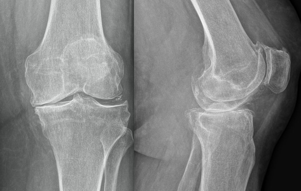 Röntgenbild: Kniearthrose (Gonarthrose)