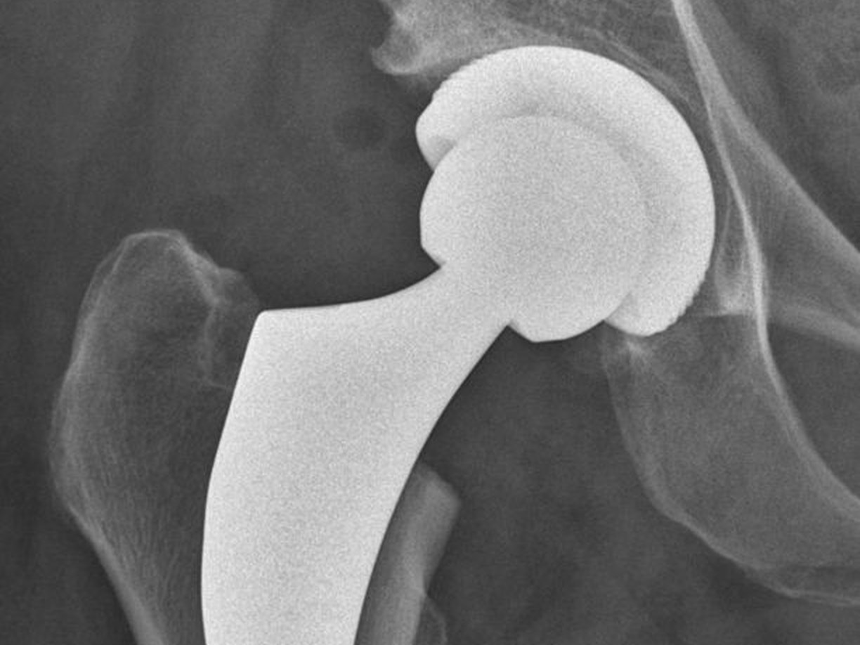 Röntgenbild: minimal invasive Hüftprothese (AMIS)
