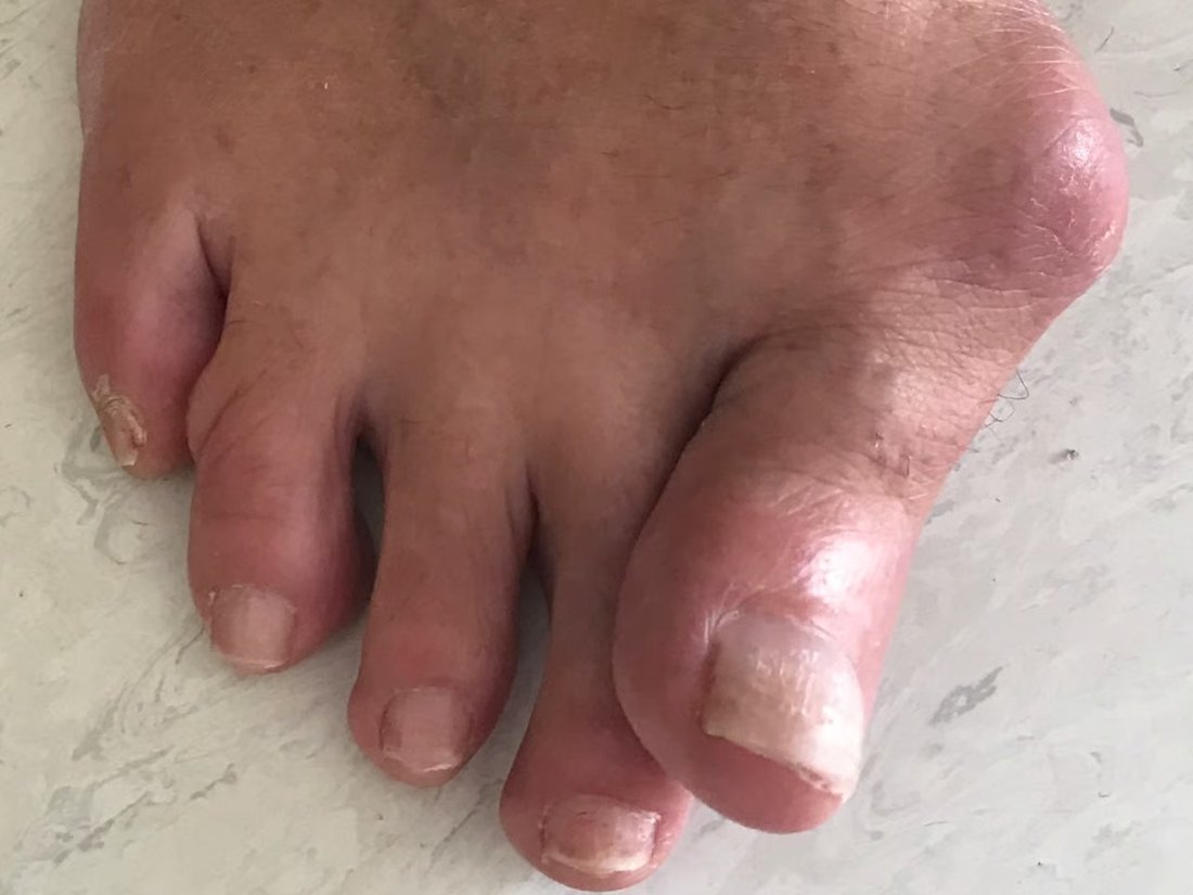 Fußkorrektur: Hallux valgus und Hammerzehen