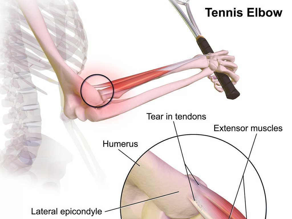 Illustration: Tennisellbogen
