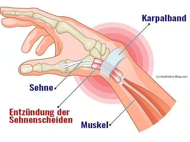 Illustration: Sehnenscheidenentzündung