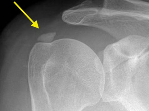 Röntgenbild: Kalkschulter (Tendinosis calcarea)