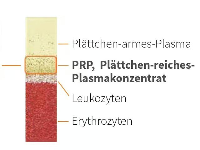 Schema: Plättchenreiches Plasma (PRP)