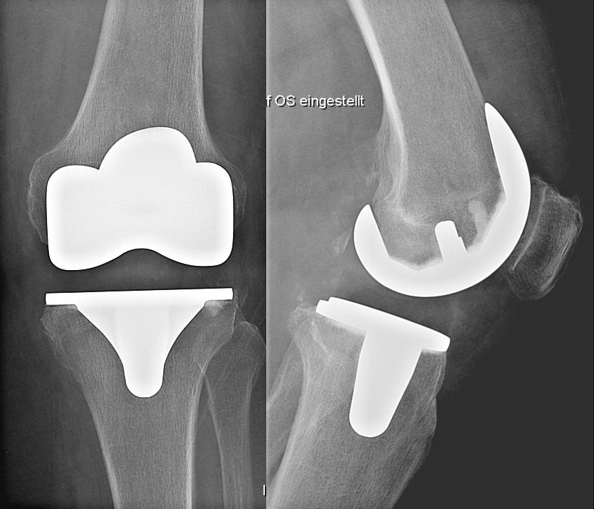 Röntgenbild: Knie-Totalprothese