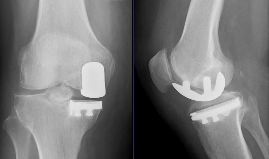 Röntgenbild: Schlittenprothese am Knie